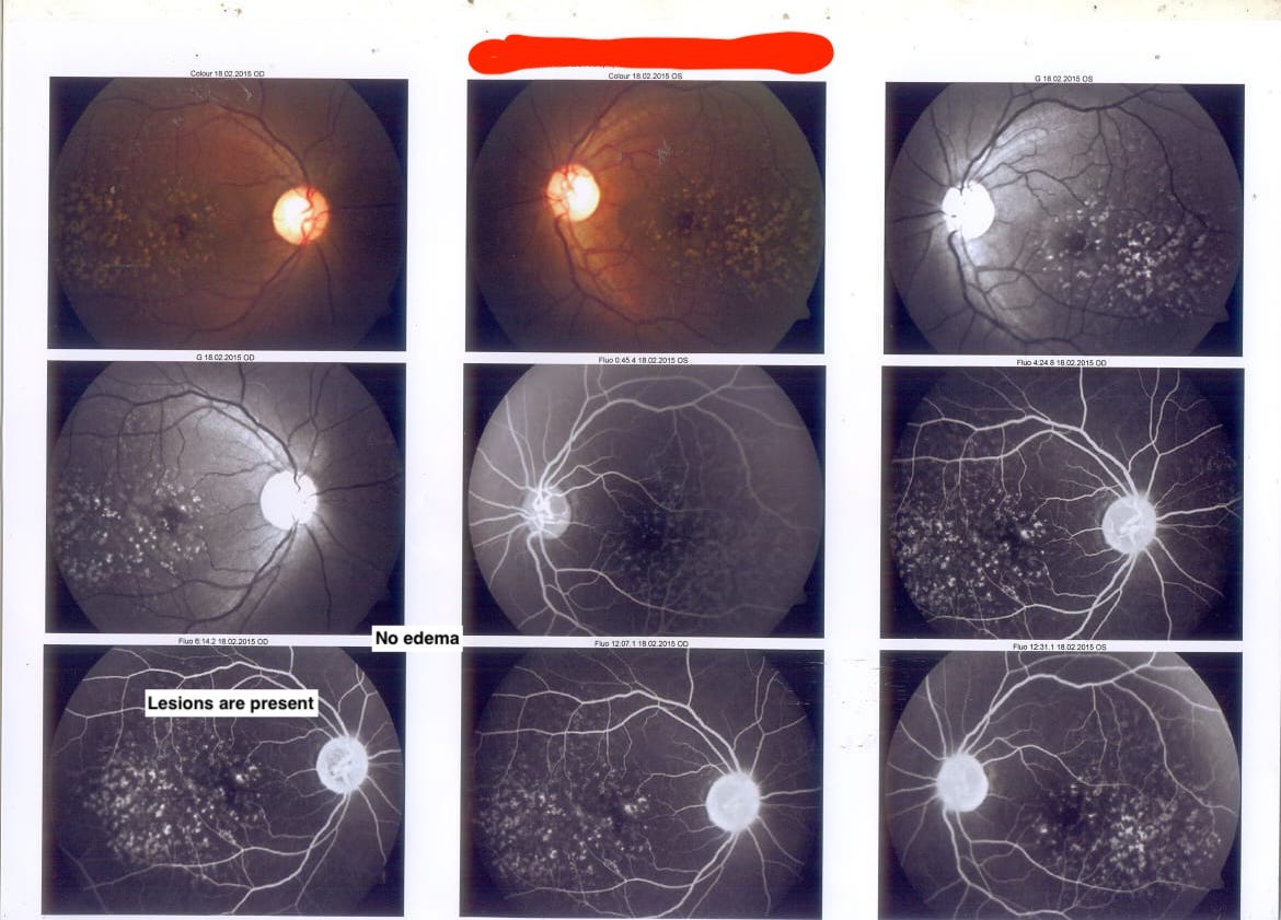 fundus_flourosin_angiography__feb_2015.jpeg