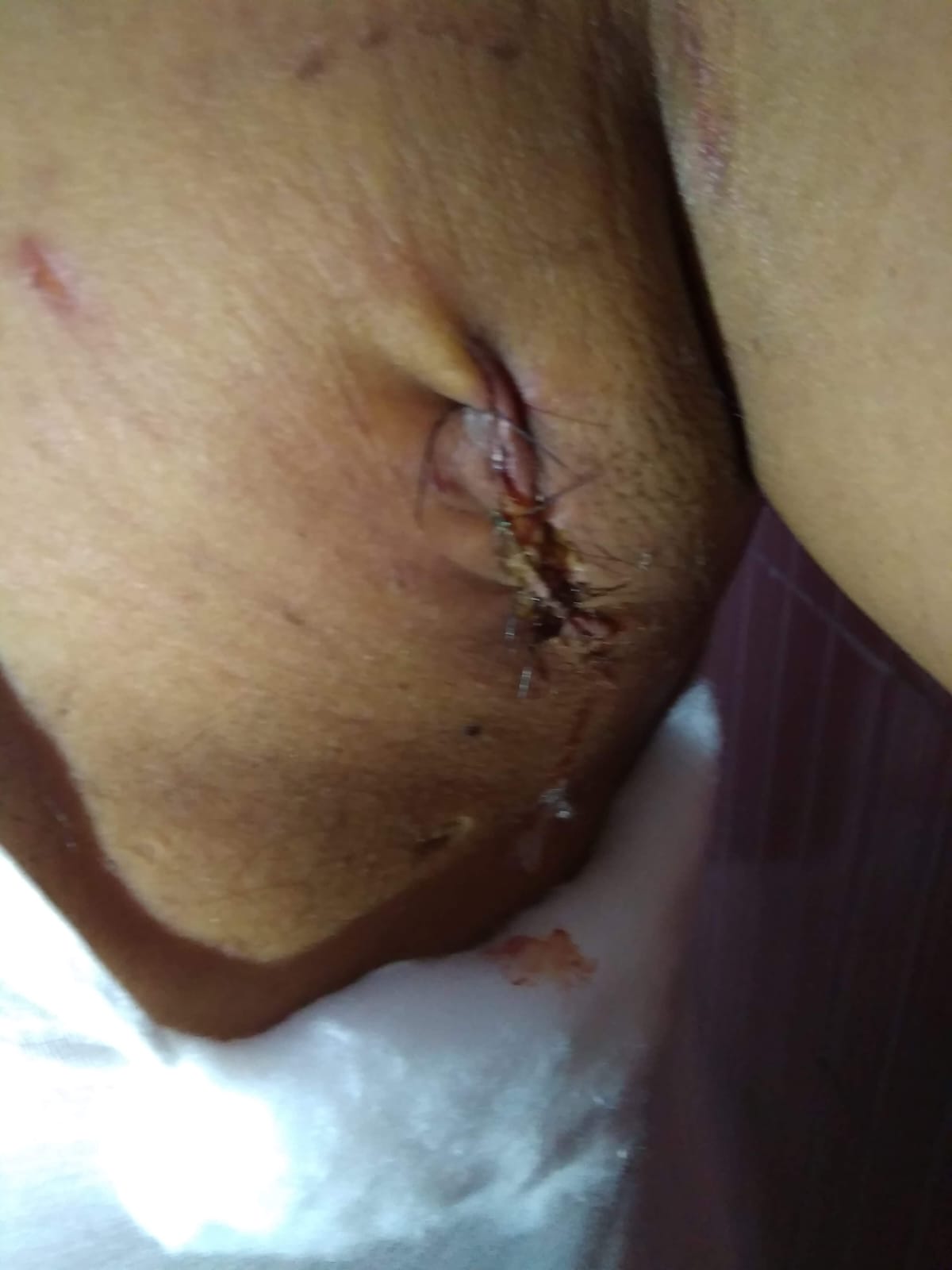 after_biopsy_dated_1_12_2018.jpg