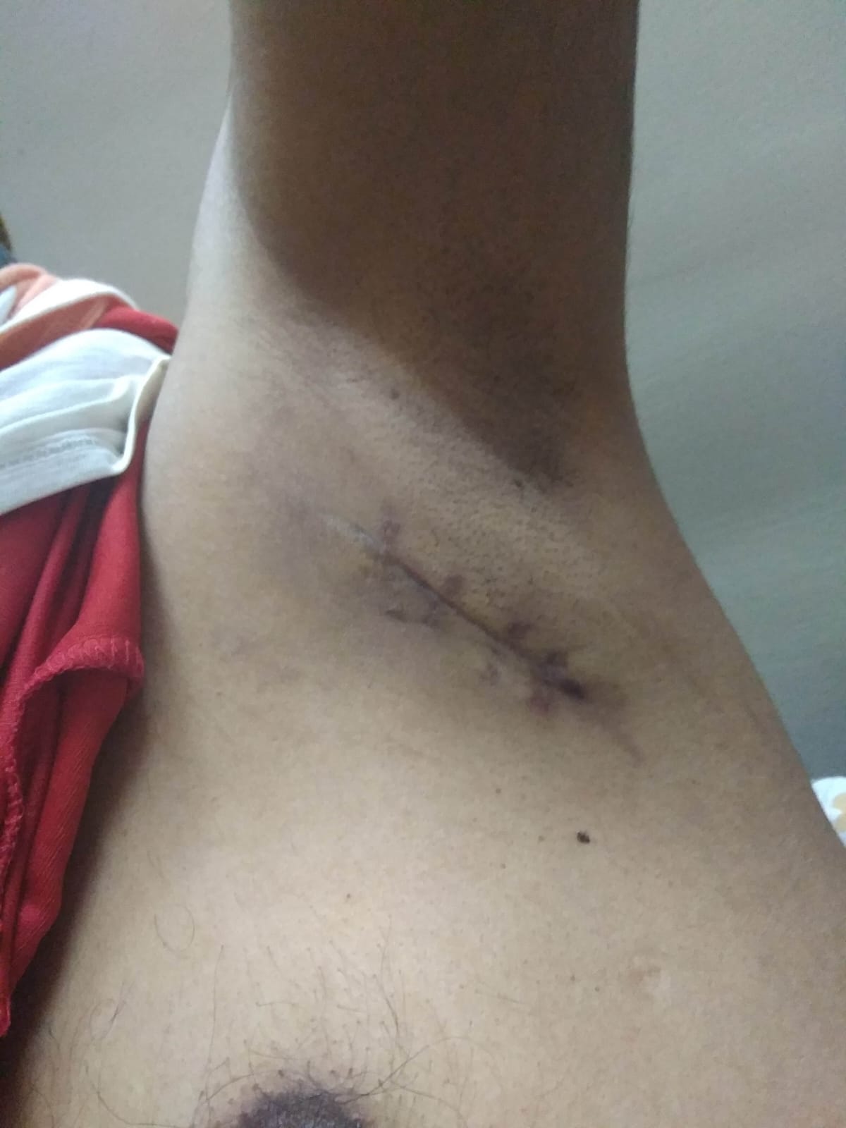 after_biopsy_dated_28_4_2019.jpg