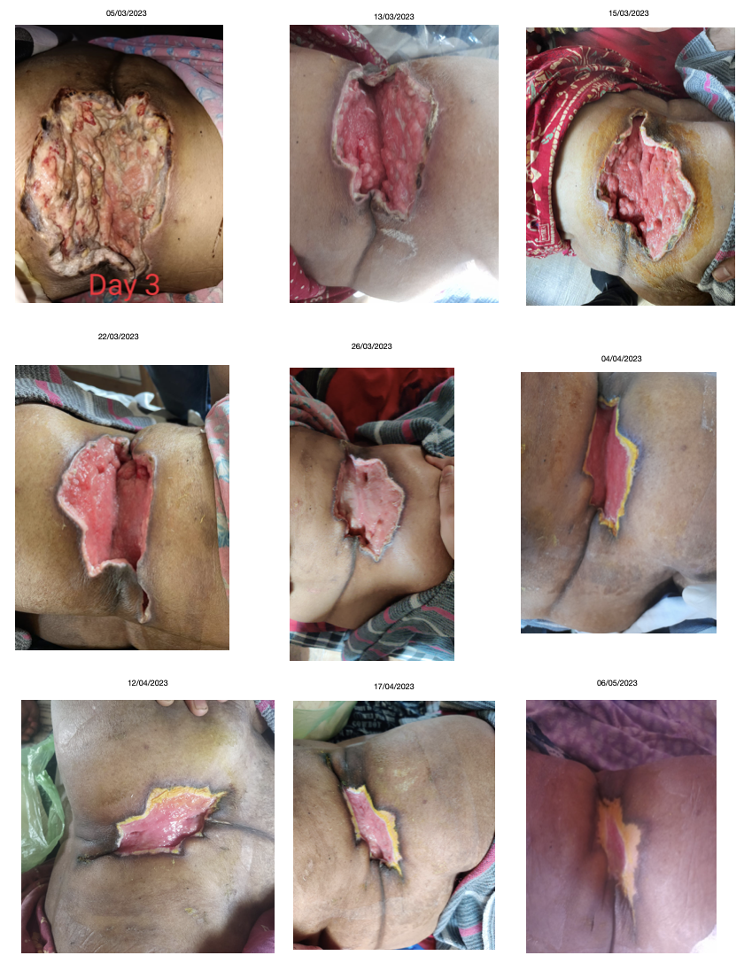 images_of_the_wound_taken_throughout_the_treatment.png