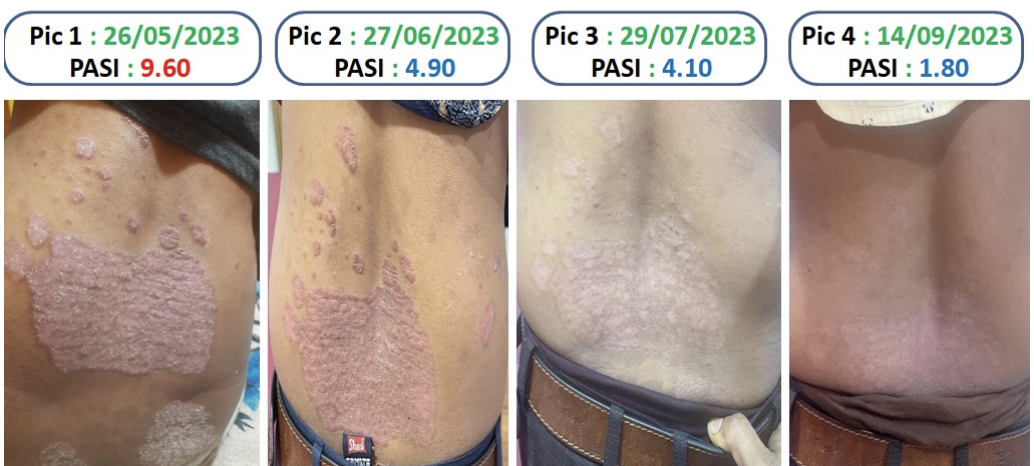 back_images_with_pasi_score.png