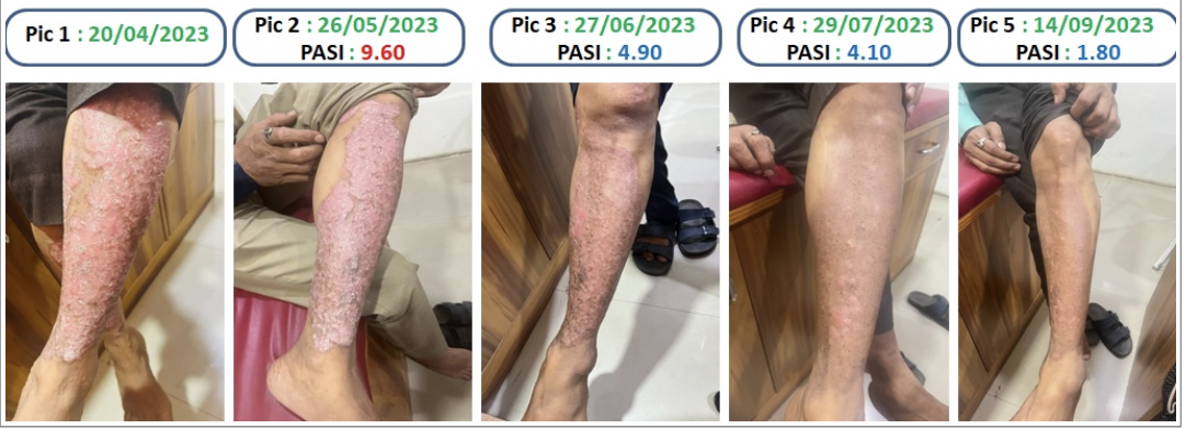 leg_leg_images_with_pasi_score.png