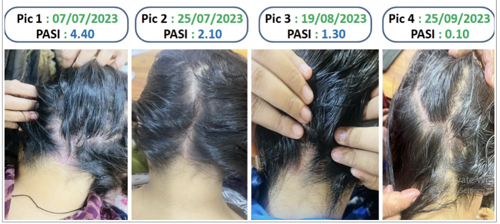 image_of_the_lesions_at_the_back_of_the_head_with_pasi_score.png