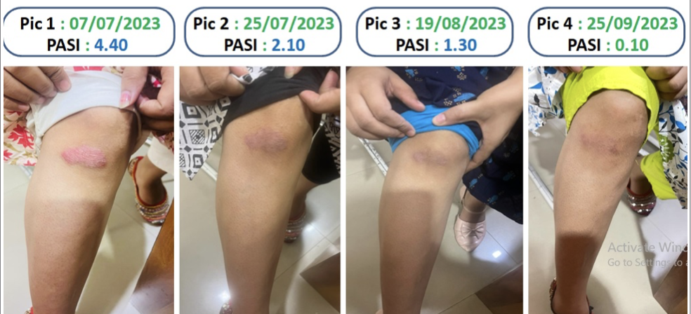 image_of_the_lesions_in_the_right_knee_with_the_pasi_score.png