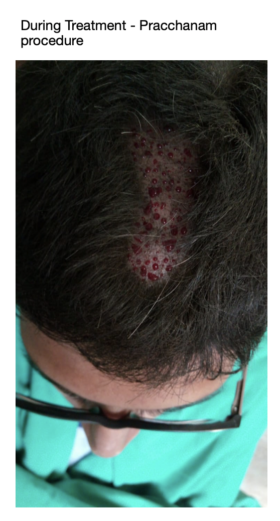 during_treatment_image.png