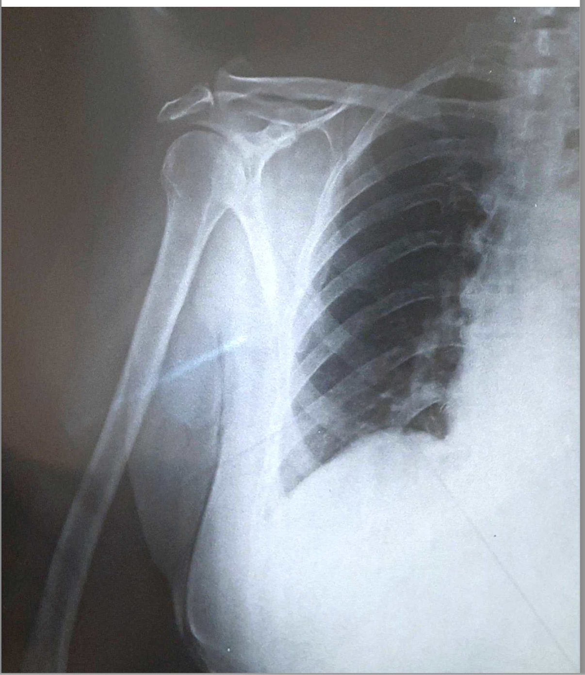 xray-_right_shoulder_ap.png