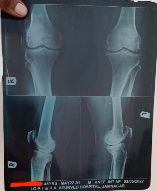 x-ray_bl_knee_joint.jpeg