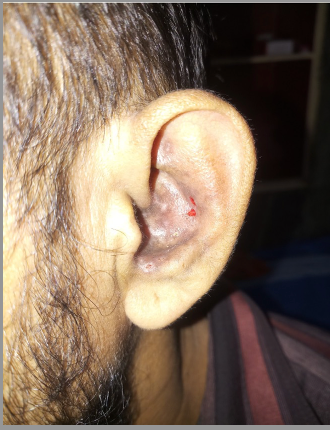 rashes_in_the_left_ear.png